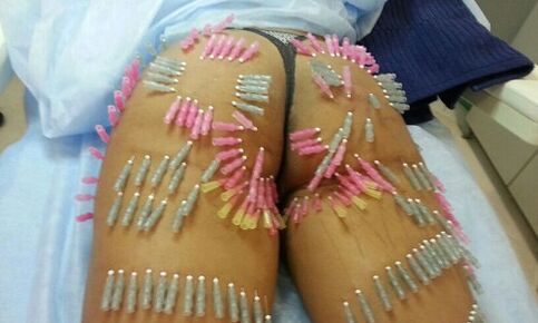 levantamento de glúteos